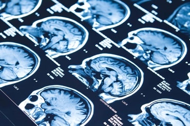 WUMed | Potwierdzono działanie leku, który hamuje zanik tkanki mózgu u chorych na SM